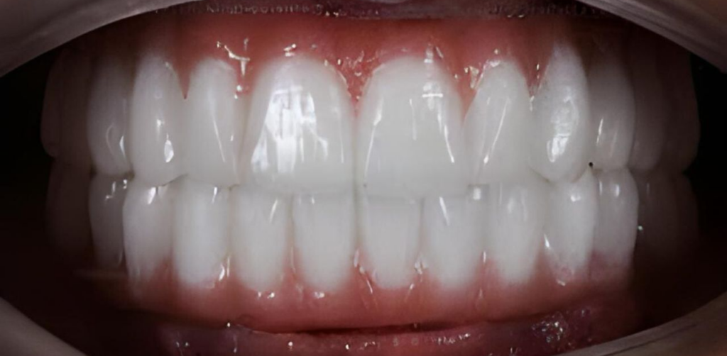 denti fissi zirconio dentista impianti