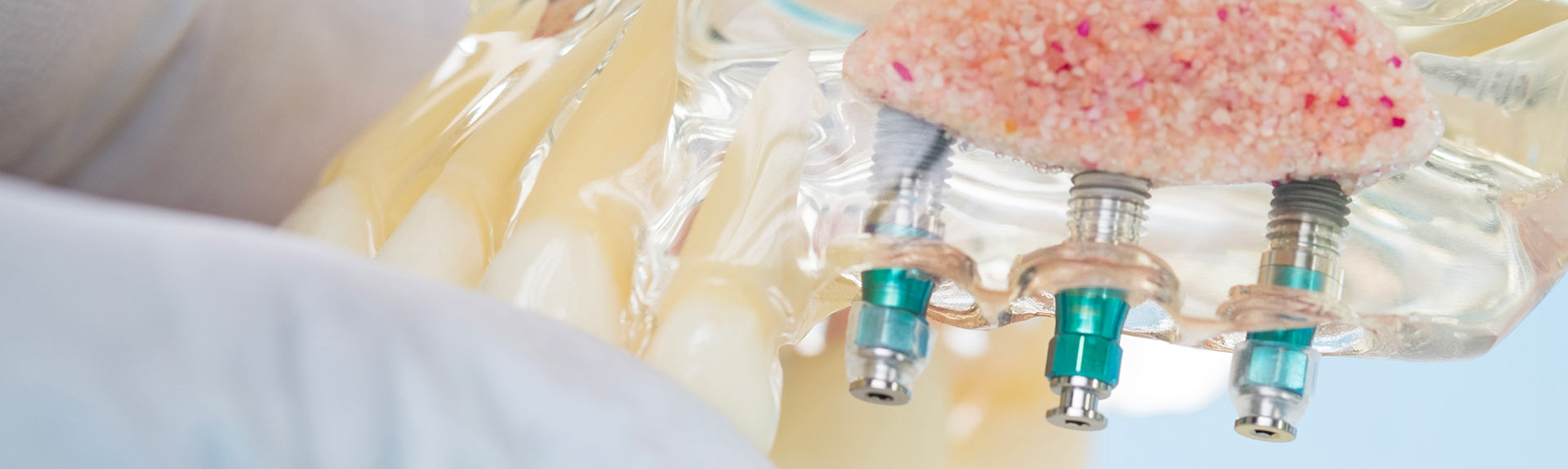 implantologia | Studi Odontoiatrici White Trento