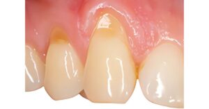 macchie gialle sui denti come toglierle cosa sono